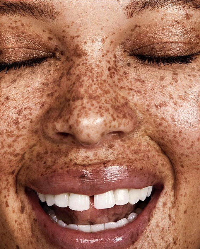 Les t�ches de rousseur ou la beaut� du hasard